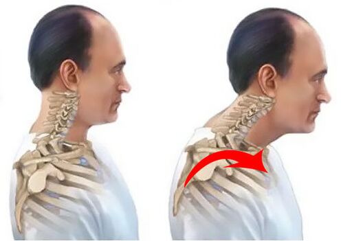 Healthy spine and disease