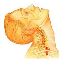 Cervical spine tumors