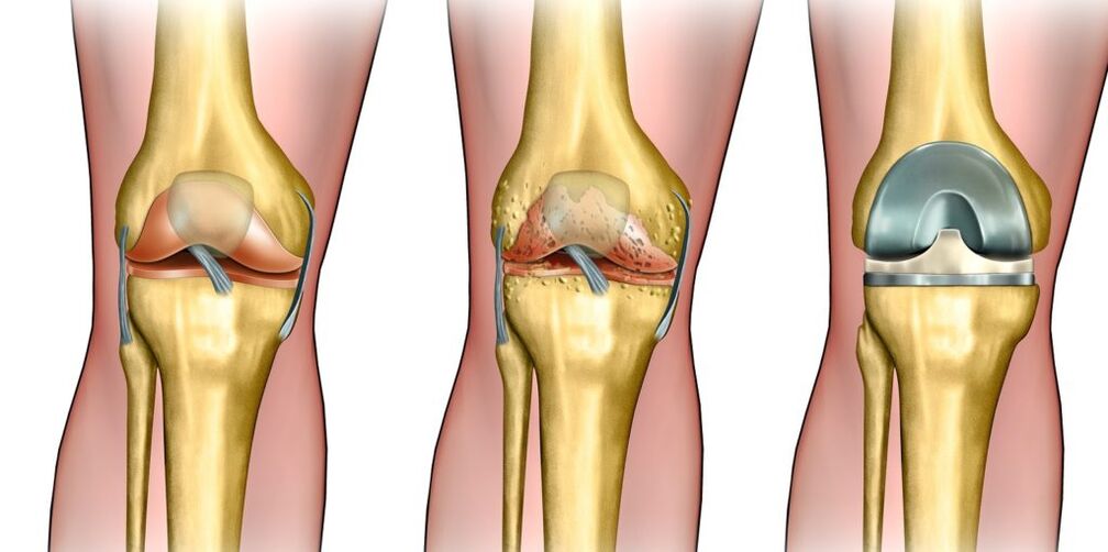 Arthrosis of knee joints