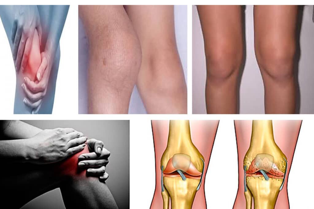 Symptoms of knee arthritis